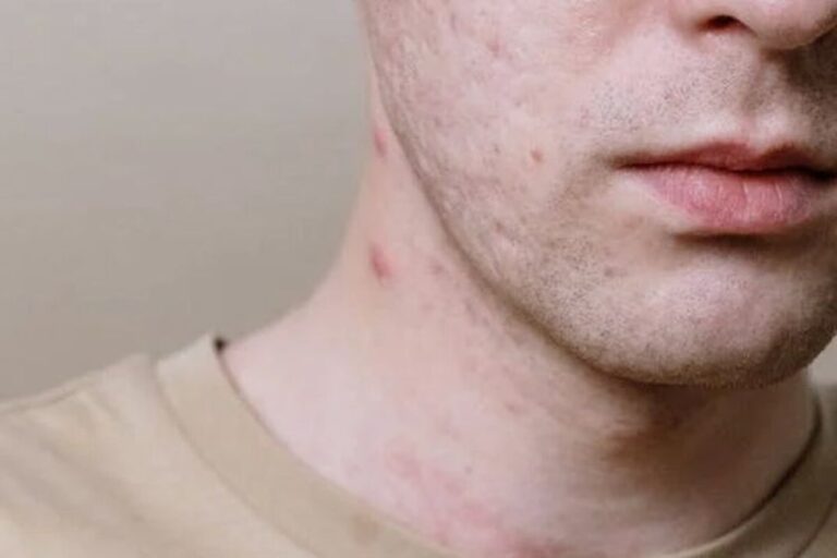 Jerawat di Leher Tiba-tiba Muncul di Usia 40, Ini Sebabnya