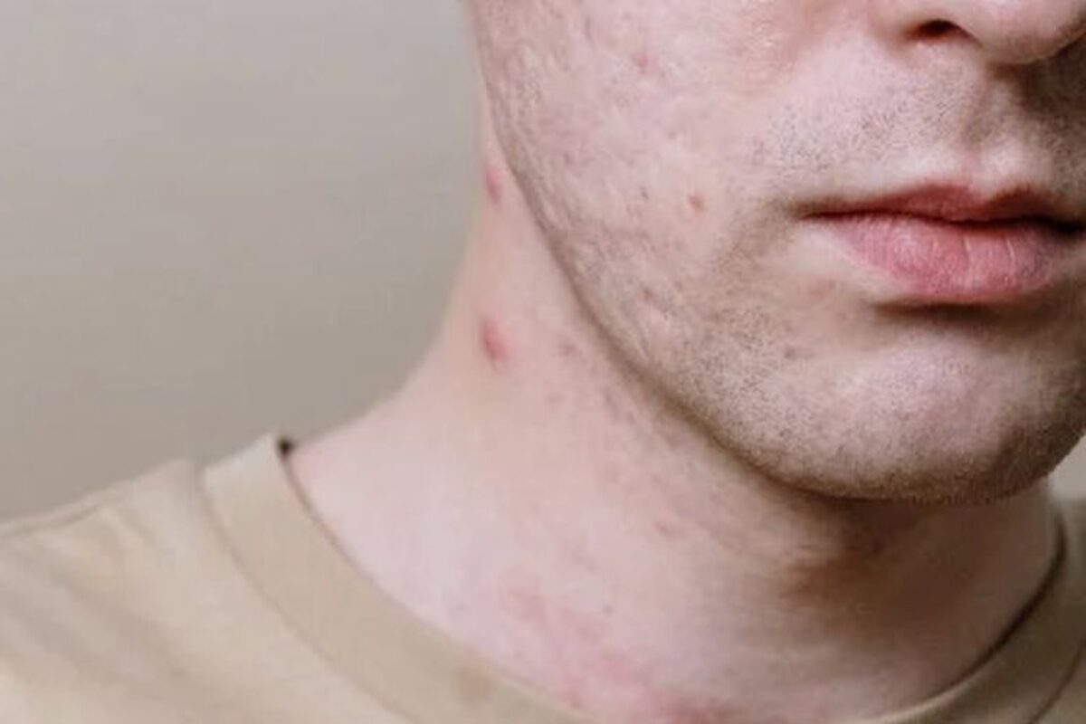Jerawat di Leher Tiba-tiba Muncul di Usia 40, Ini Sebabnya